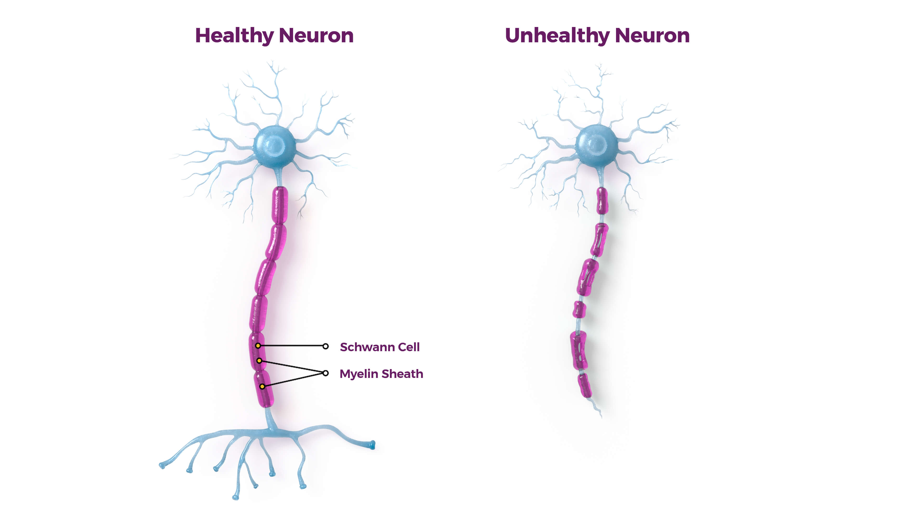 CMT unhealthy neuron